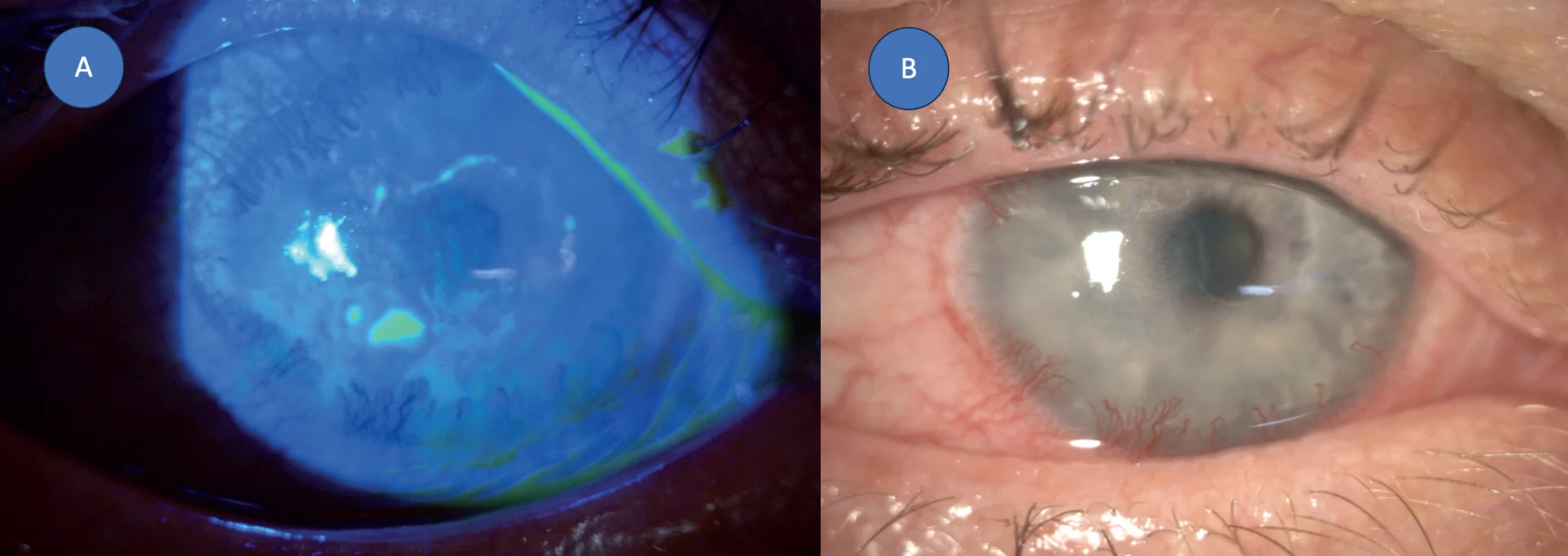Stromal immune keratitis with corneal neovascularization and epithelial defect – (A) image with fluorescein dye, (B) image without fluorescein dye