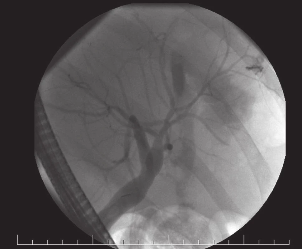 ERCP: BL z periferního žlučovodu
Fig 1. ERCP: BL from peripheral bile duct