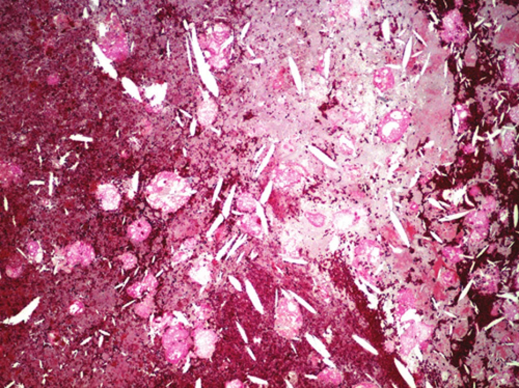 Detail oblasti nepravého aneuryzmatu, cholesterolové hlatě. Barveno modrým trichromem (zvětšeno 100x).