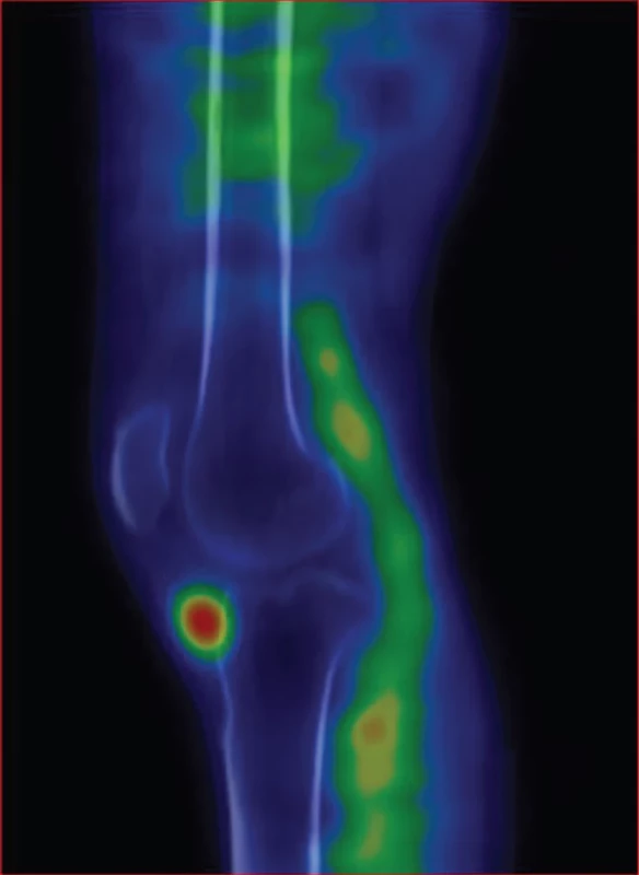 SPECT/CT pravého kolenního kloubu v sagitálním řezu v časné fázi – krevní pool zvýšen v oblasti, která odpovídá lokalizaci hluboké infrapatelární burzy.