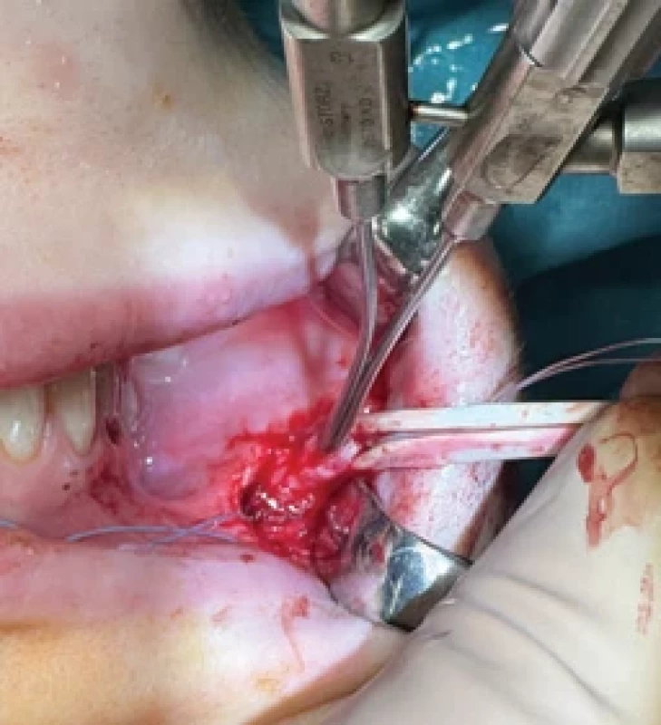 Insertion of a modular sialendoscope after incision of the megaduct.