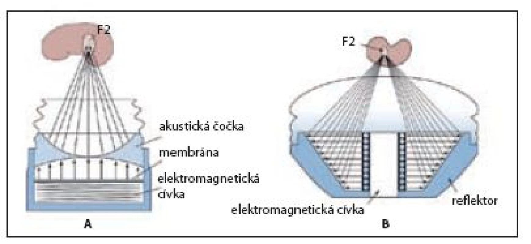 Elektromagnetický princip generování rázové vlny
A – litotryptory Dornier a Siemens; B – litotryptory Storz
Fig. 6 Electromagnetic shock wave generator
A – Dornier, Siemens lithotripters; B – Storz lithotripter