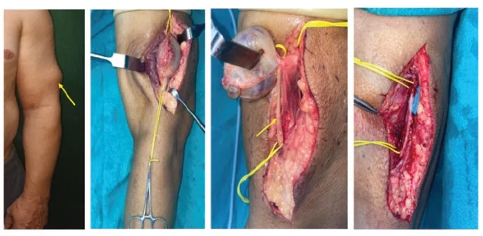Schwannoma arising from the left side main radial nerve. The tumor appears encasing one nerve fascicle, which was also removed along with the tumor and nerve continuity was re-established using single sural nerve cable graft.