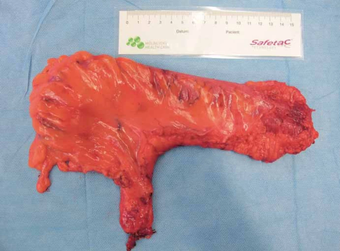 Robotická resekce rekta s TME – fotografie resekátu.
Fig. 1. Robotic assisted low anterior resection with TME – photo of the resection specimen.