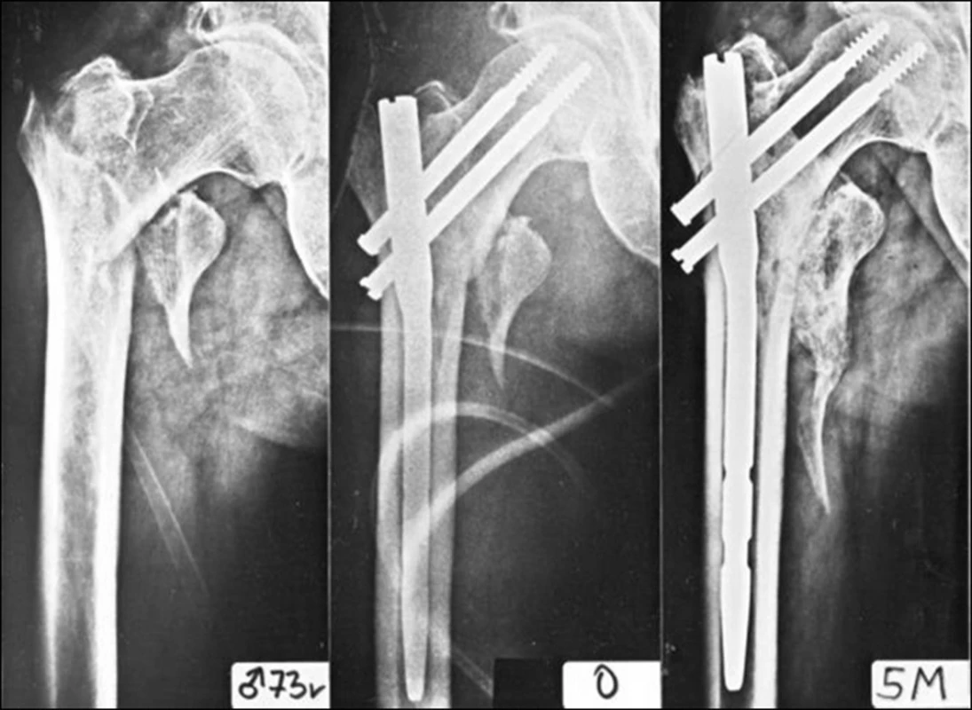 Osteosyntéza nestabilní pertrochanterické zlomeniny PFN (Medin) bez distálního zajištění: a – nestabilní zlomenina, odlomení intertrochanterické kristy s oběma trochantery; b – osteosyntéza PFN, oba skluzné šrouby procházejí intaktní laterální kortikalis distálního fragmentu a brání rotaci distálního fragmentu na hřebu i zapadnutí hřebu do dřeňového kanálu; c – stav po 5 měsících, zlomenina je zhojena, došlo pouze k mírnému zkrácení krčku femuru, postavení hřebu v distálním fragmentu je stejné.
Fig. 6: Internal fixation of unstable pertrochanteric fracture by PFN (Medin) without distal locking: a – an unstable fracture, separation of the intertrochanteric crest with both trochanters; b – internal fixation by PFN, both lag screws pass through the intact lateral cortex of the distal fragment and prevent rotation of the distal fragment on the nail as well as subsidence of the nail in the medullary canal; c – after 5 months, the fracture has healed with only a slight shortening of the femoral neck, the position of the nail in the distal fragment is the same.