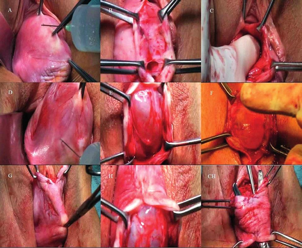 Základní kroky před vlastní inzercí kotveného syntetického implantátu pro řešení defektu ve všech kompartmentech.