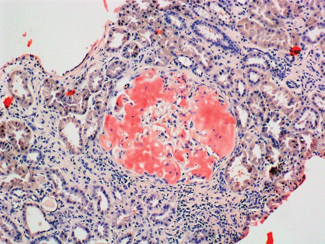 Kongo červeň, zvětšení 100x
Kongo pozitivní depozita v glomerulu ledviny
(Poskytnuto MUDr. Pavlou Látalovou, Ústav klinické a molekulární patologie, Fakultní nemocnice Olomouc.)