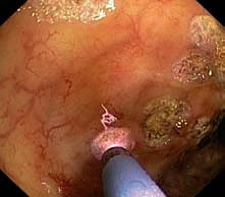 Argón plazma koagulácia teleangiektázií – detail.
Fig. 3. Argon plasma coagulation of telangiectasia – detail.
