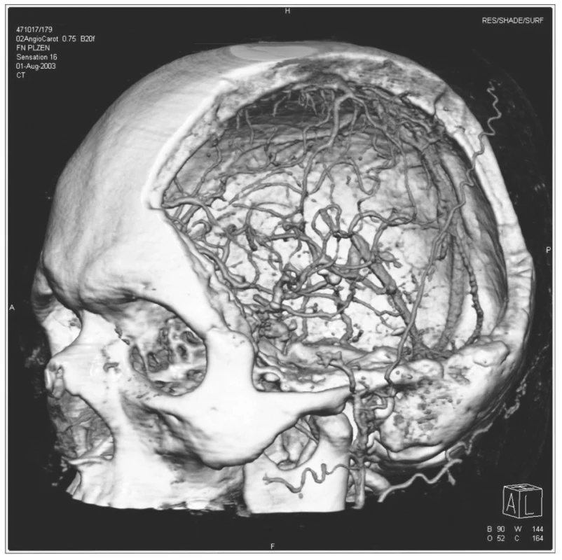 3D CT zobrazující rozsáhlou hemisferální dekompresivní kraniektomii
Pic. 1. 3D CT depicting extensive hemispheral decompressive craniectomy