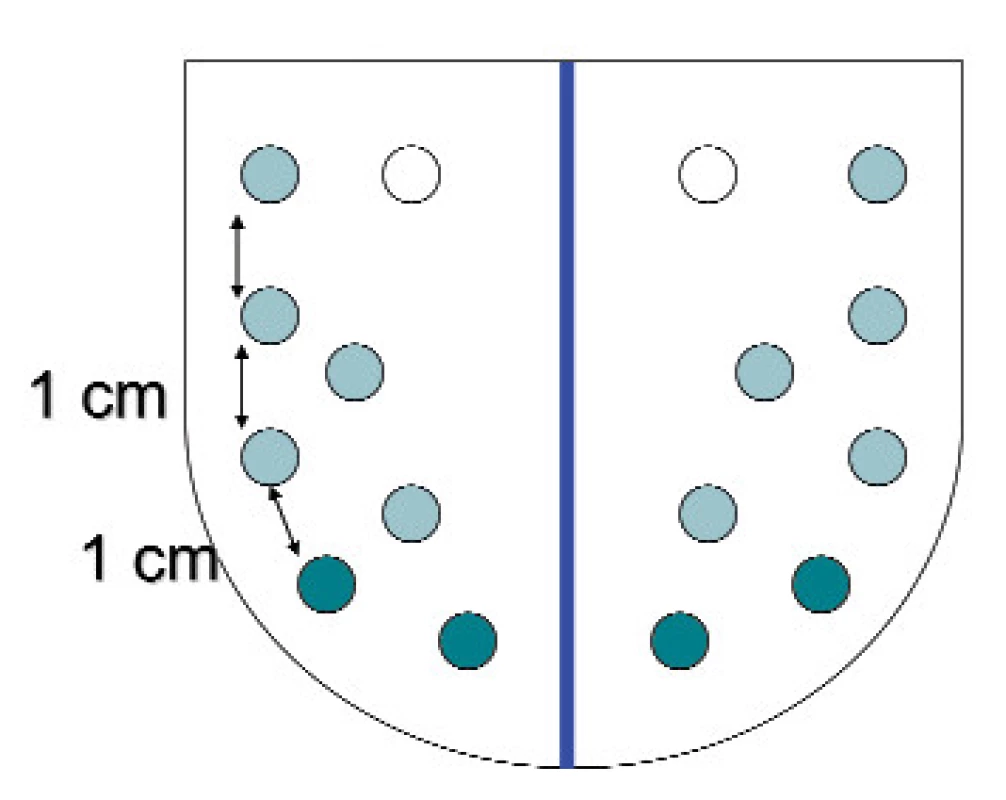 Rozšířená (multiplicitní) 8–16 vz biopsie s laterálními vzorky.