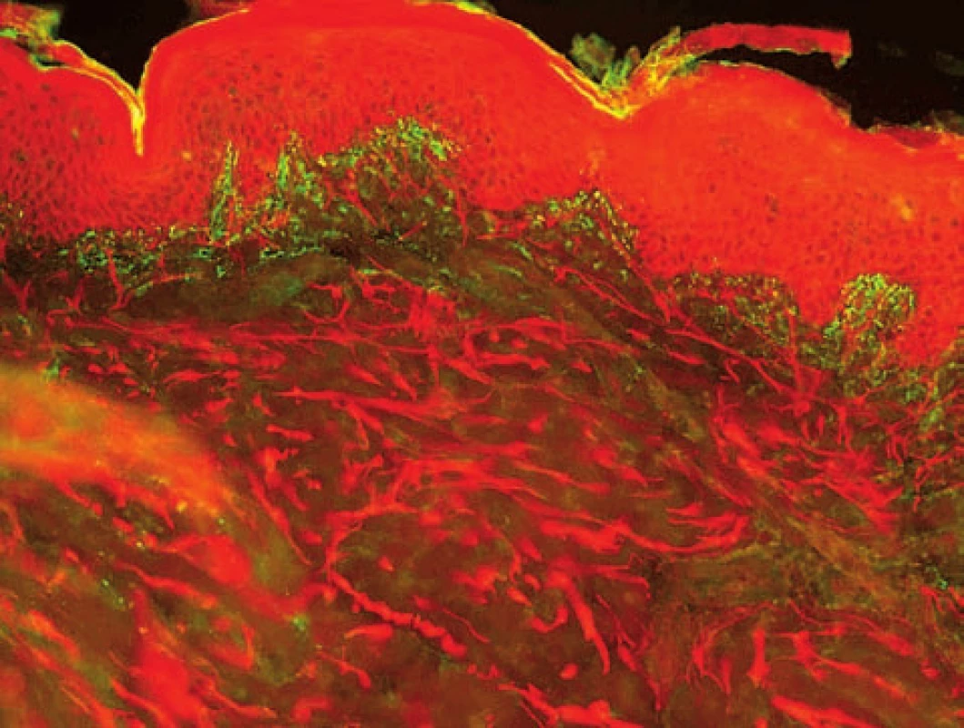 Makovité uloženiny IgA v papilách u dermatitis herpetiformis