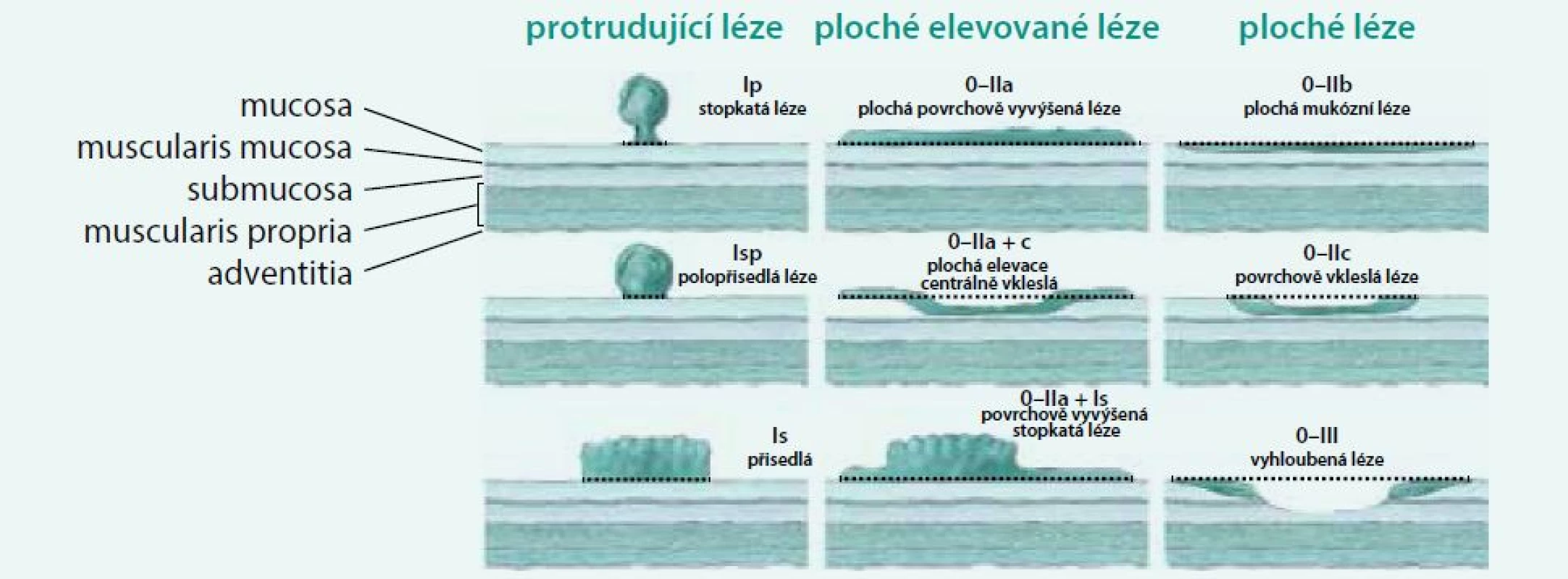 Pařížsko-Japonská morfologická klasifikace