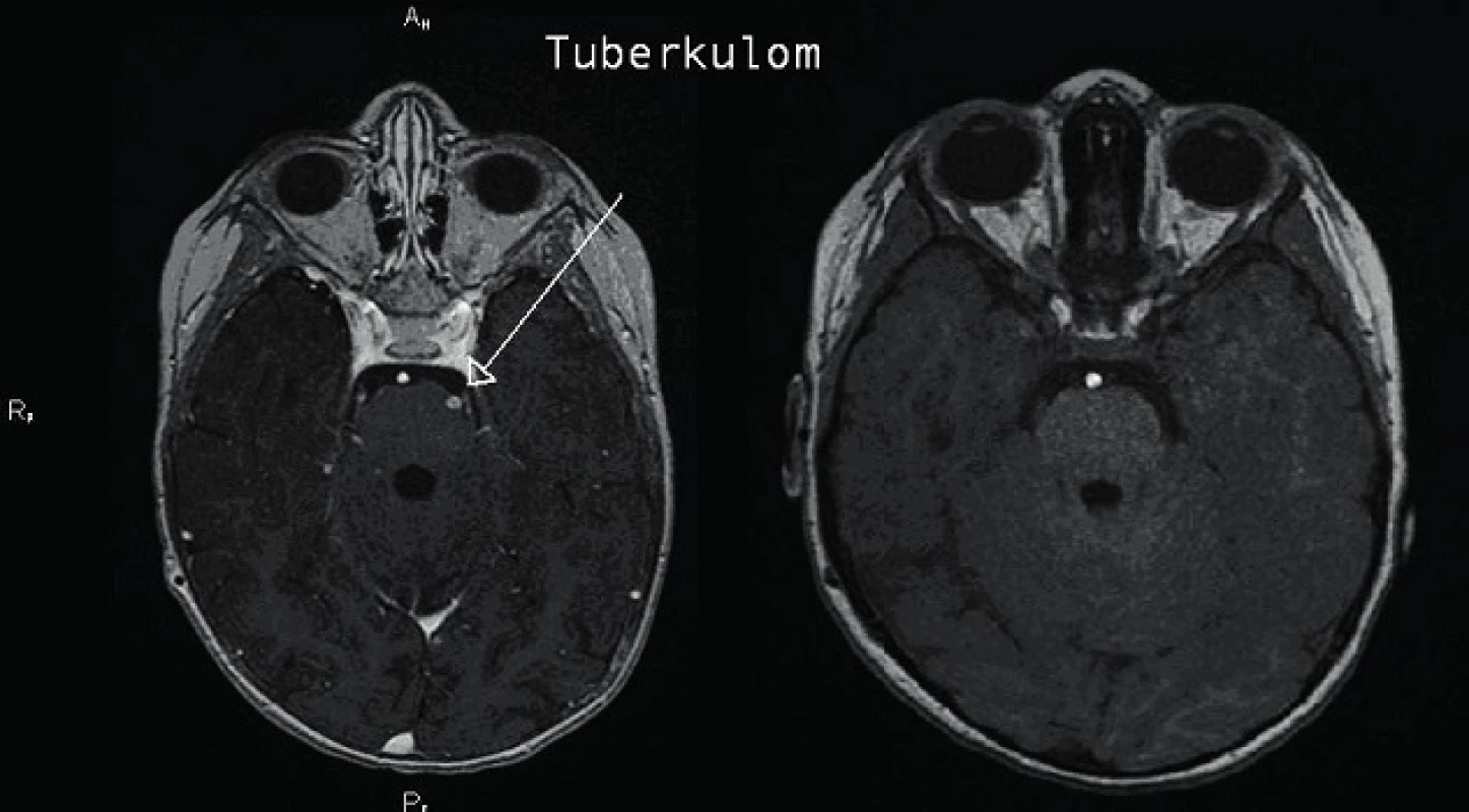 Regrese tuberkulomu po léčbě.
Fig. 6. Regression of tuberculoma.