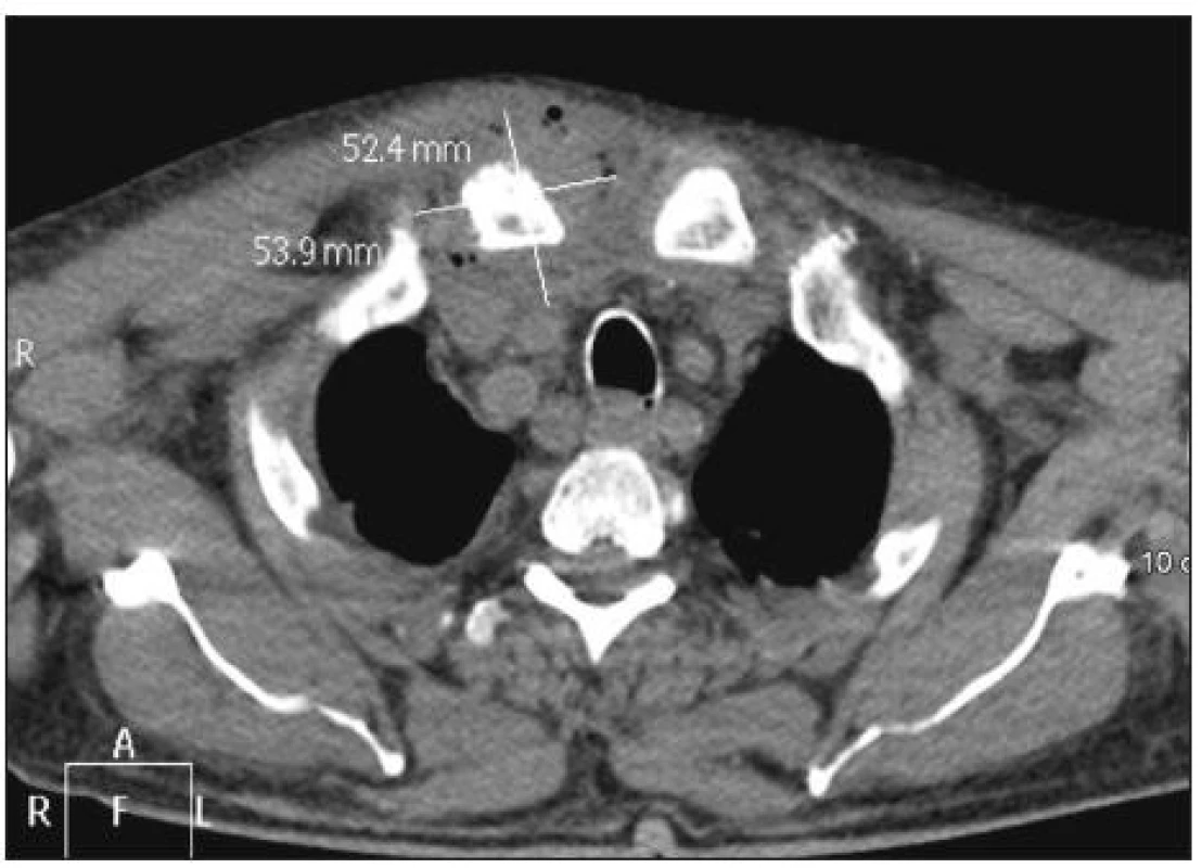 Absces sternoklavikulárního kloubu vpravo (kazuistika č. 1)
Fig. 1. Abscess of the right sternoclavicular joint (case report No. 1)
