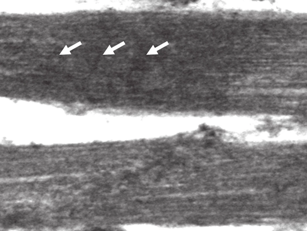 Neuspořádané Z-proužky, sarkomera bez příčného pruhování, setřelá ultrastruktura Z-disků (šipka), I-proužků. (elektronogram, zvětšení 15 000x).