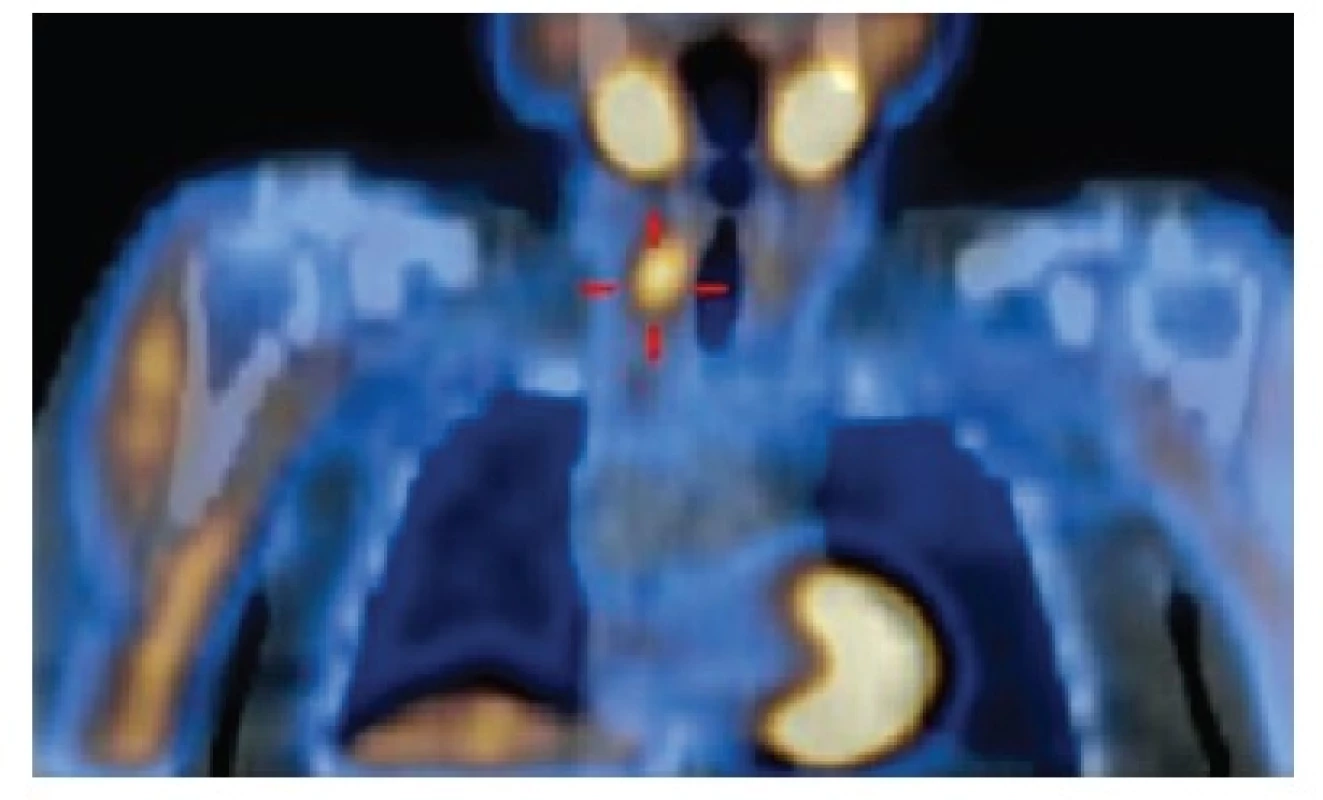 Hyperplastické příštítné tělísko vpravo dole, hodnoceno jako adenom příštítného tělíska, indikováno k operaci 
Fig. 1: Hyperplastic parathyroid gland on the right at the bottom, classified as parathyroid adenoma, indicated for surgery