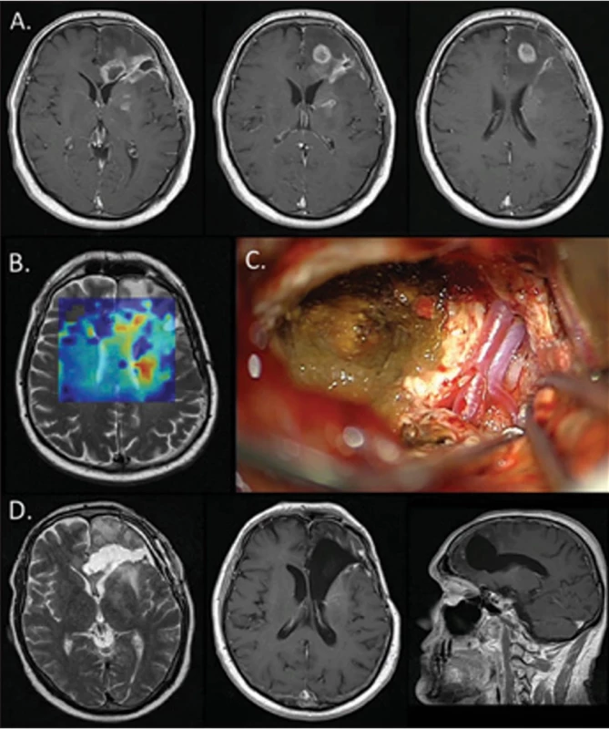 MR 142 měsíců (11,8 roku) žijícího pacienta s glioblastomem, operovaného  v 50 letech (3 operace během 1 roku, radiochemoterapie, 100 cyklů temozolomidu).  (A) MR při první recidivě (4 měsíce po primooperaci) zobrazující blízkost enhancujícího  nádoru ke komoře (přítomno vstupně) a postižení hlubokých struktur. (B) Spektroskopie  MR T2 vyloučila pseudoprogresi. (C) Resekce v oblasti corpus callosum. (D) Vlevo – MR  časně po resekci, uprostřed a vpravo – T1 s k.l. dlouhodobá remise nádoru a dobrý kli nický stav pacienta s Karnofského skóre 90 %  Fig. 5. MRI of a 142-month (11.8-year) living male patient with glioblastoma, operated on  at the age of 50 (3 surgeries within 1 year, radiochemotherapy, 100 cycles of temozolo mide). (A) MRI at fi rst recurrence (4 months after primary surgery) showing the proximity  of the enhancing tumor to the ventricle (present at baseline) and involvement of deep  structures. (B) MRI spectroscopy ruled out pseudoprogression. (C) Resection in the cor pus callosum area. (D) Left – MRI T2 shortly after resection, center and right – T1 with  contrast long-term tumor remission and good clinical condition of the patient with Kar nofsky Performance Status at 90%.