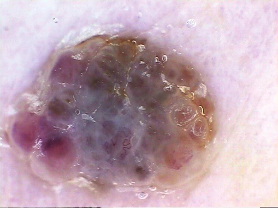 Metastáze melanomu do kůže