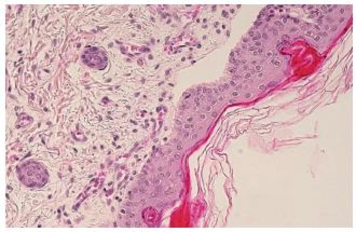 Epidermolysis bullosa. Subepidermálny pľuzgier s chudobnou celulizáciou (HE, 120x).