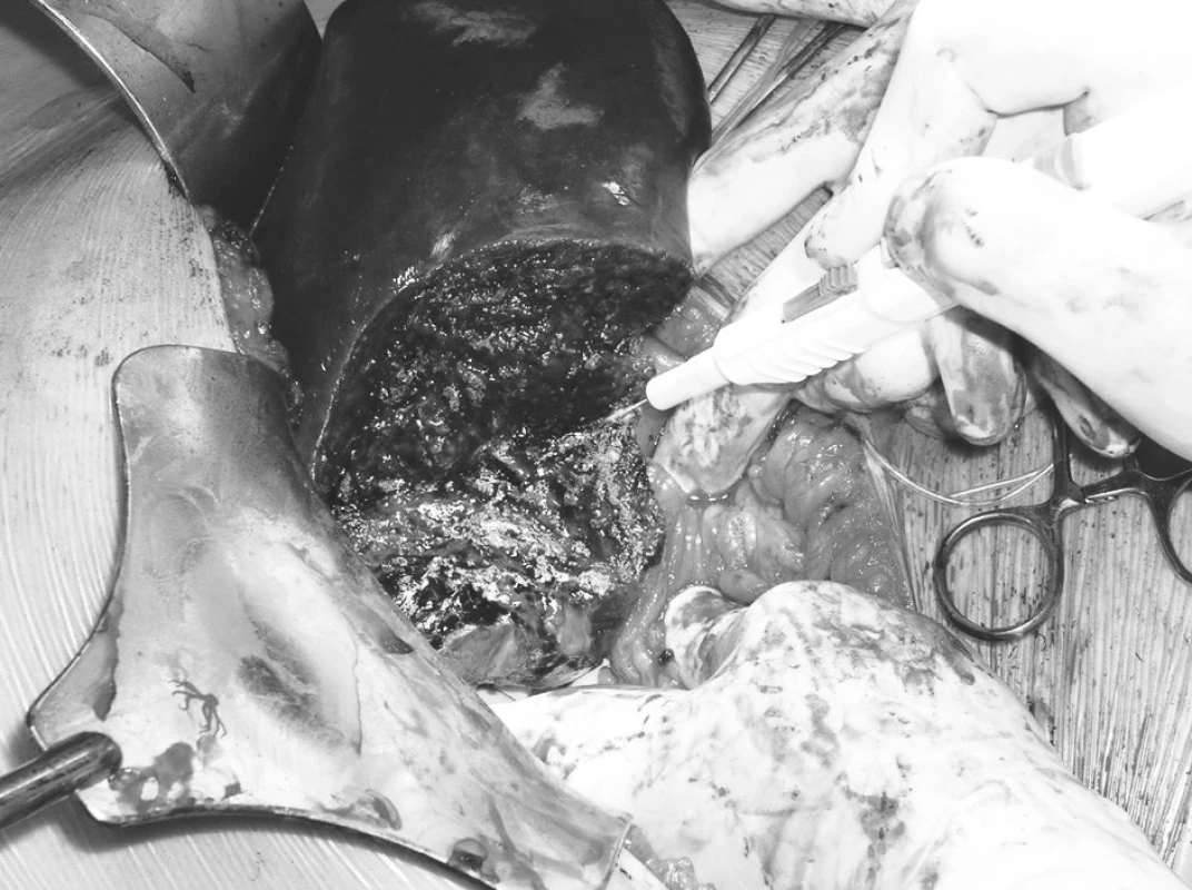 Stav po enukleaci hemangiomu z pravého laloku jater – argonová koagulace plochy
Pic. 4. A condition following enucleation of the right liver lobe hemangioma– argon coagulation of the ar