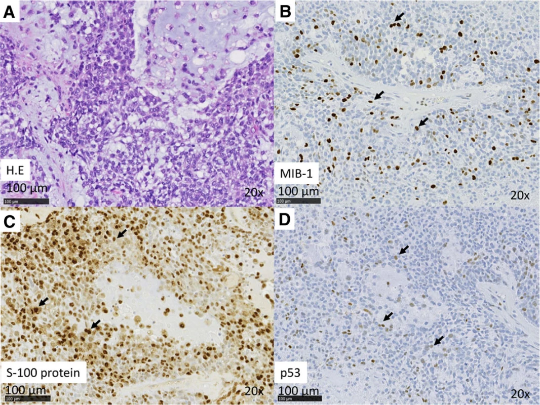 (a–d) Case 1. Histopathologic features of MEC. a H&amp;E stain. b IHC analysis reveals Ki67 positivity in nuclei. The MIB index was approximately
20 %. c IHC analysis revealed S-100 positivity in the cytoplasm. d IHC analysis revealed p53 positivity in the nuclei
