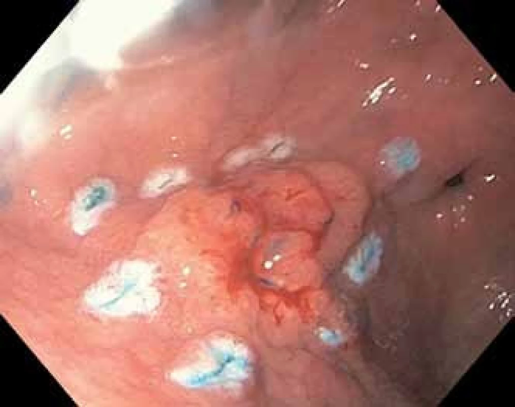 Povrchový karcinom žaludku, typ 0–II a + II c, 18 × 16 mm. Okraj označen koagulačními body.