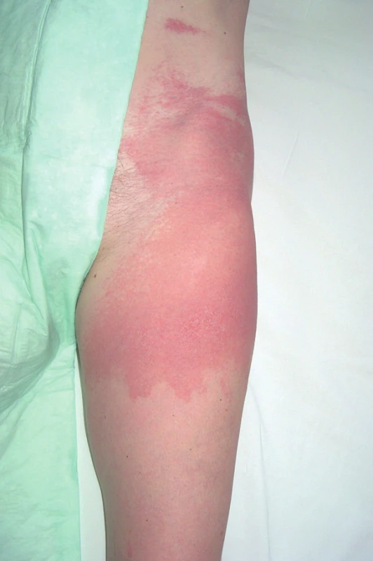 Kontaktní dermatitida na levé horní končetině (diclofenac).