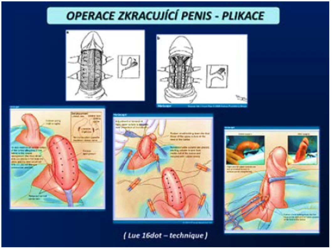 Operace zkracující penis – plikace (3, 4)
Fig. 14 Shortening penis procedures – plication (3, 4)