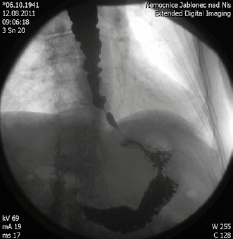 RTG pasáž jícnem s typickým obrazem achalázie III. typu se spastickými kontrakcemi.
Fig. 1. Esophagogram with the typical findings of type III achalasia with spastic contractions.
