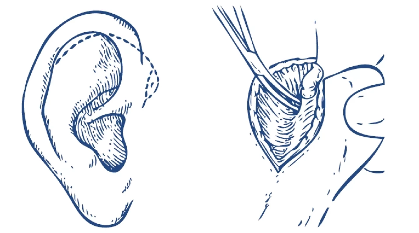 Supraurikulárny rez a identifi kácia fascia temporalis (upravené podľa [5]).