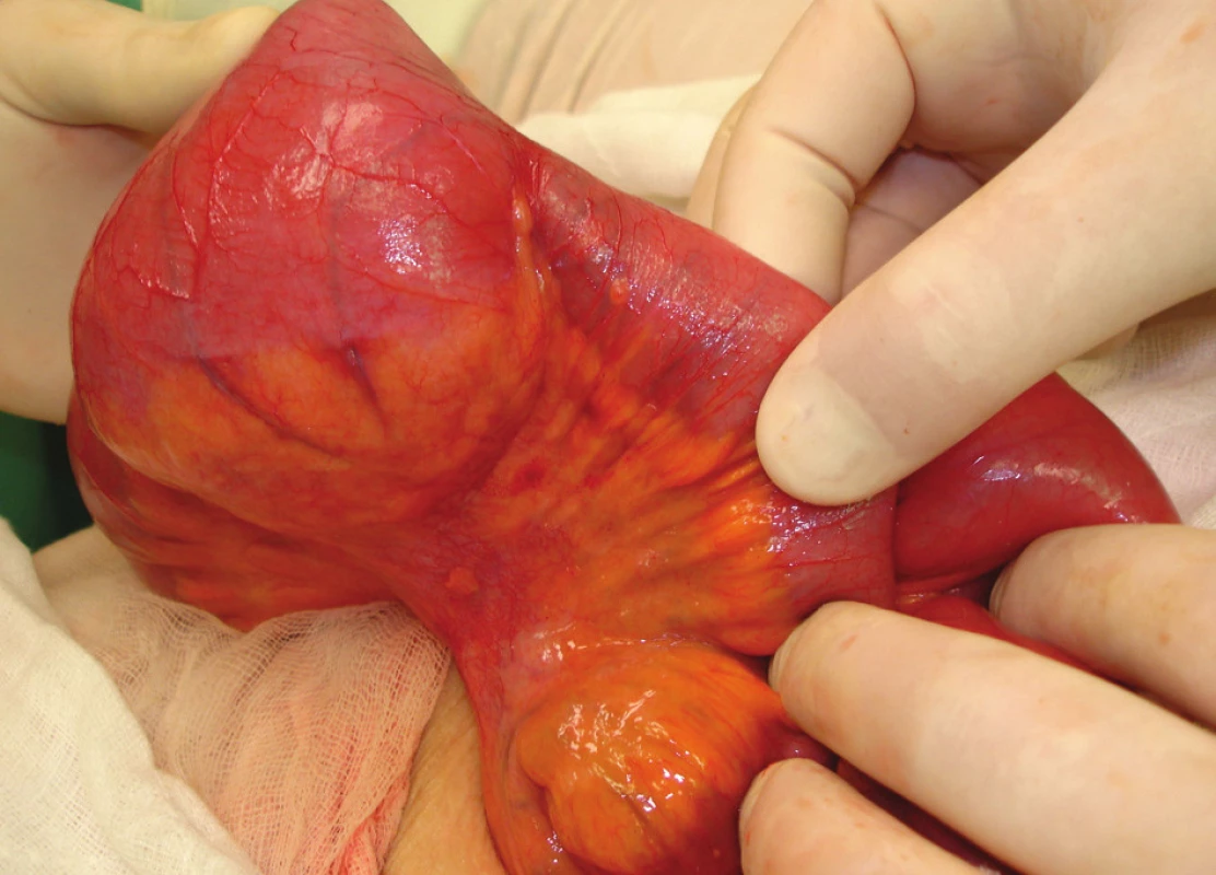 Lymfatické uzliny v závěsu ilea
Fig. 4: Lymph nodes in the mesentery