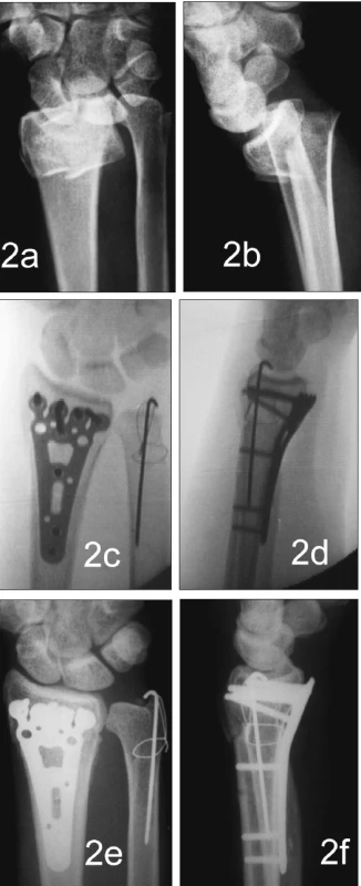 Zlomenina distálního radia typu A.2. (a, b), osteosyntéza zlomeninovou dlahou systému Aptus radius (c, d), kostní hojení po 7 týdnech (e, f); současná abrupce processus styliodeus ulnae ošetřena tahovou cerkláží Fig. 2. The distal radius fracture, type A.2. (a, b), osteosynthesis with the Aptus radius system (c, d), the bone healing at 7 weeks (e, f); the co-existing abruption of the ulnar styloid process (processus styliodeus ulnae), managed by traction cerclage