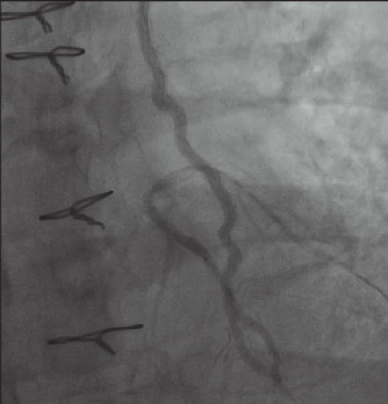 Nerozvinutý, do cílové pozice nedopravený stent ve střední RIA