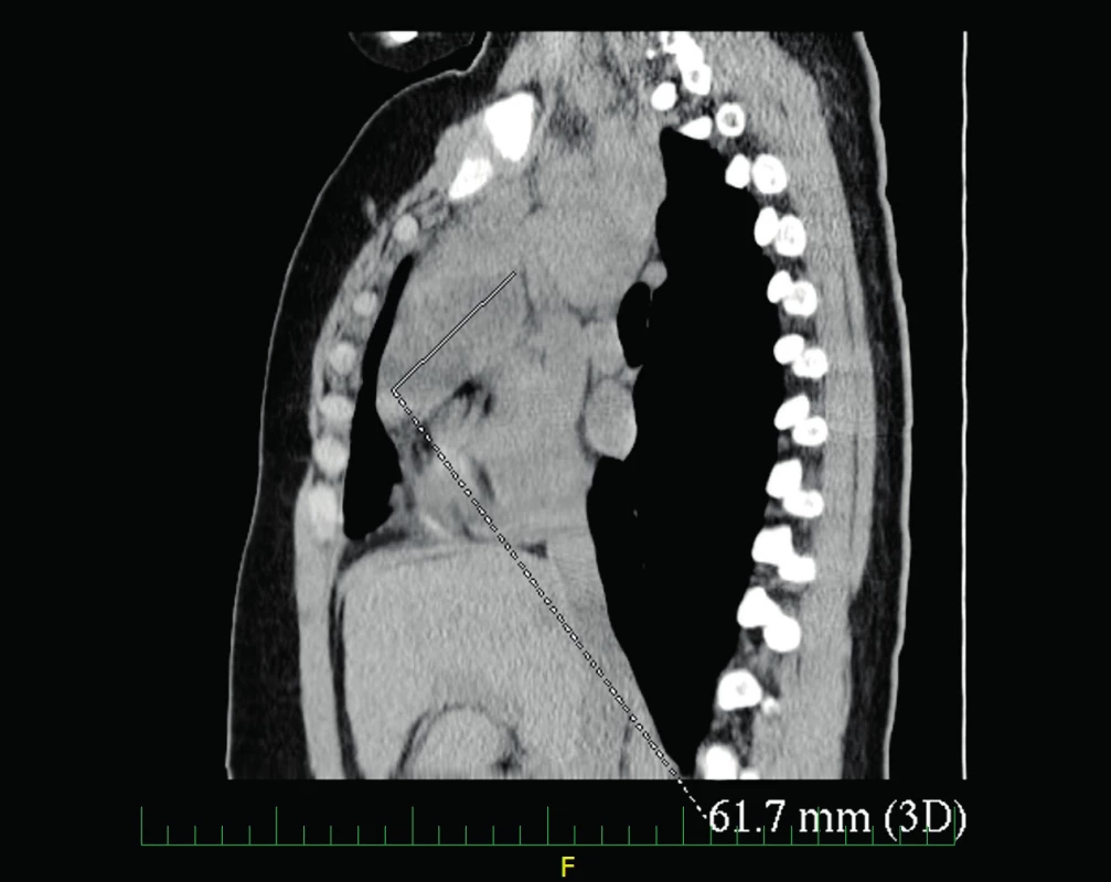 CT hrudníku – tekutinové kolekce v předním mediastinu.
Fig. 3. Chest CT – fluid collections of anterior mediastinum.