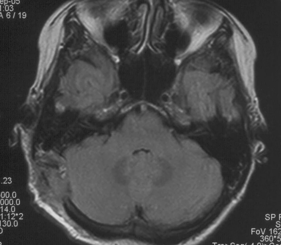 NMR dva mesiace po druhej operácii ukazuje cystické ložisko temporookcipitálne vpravo, extraaxiálne a v zadnej časti processus mastoideus, bez vzťahu k neuroštruktúram - možnosť reziduálneho tumoru a pokračovanie vývoja keratínovej cysty s rozmermi 1,4x1,3 cm.