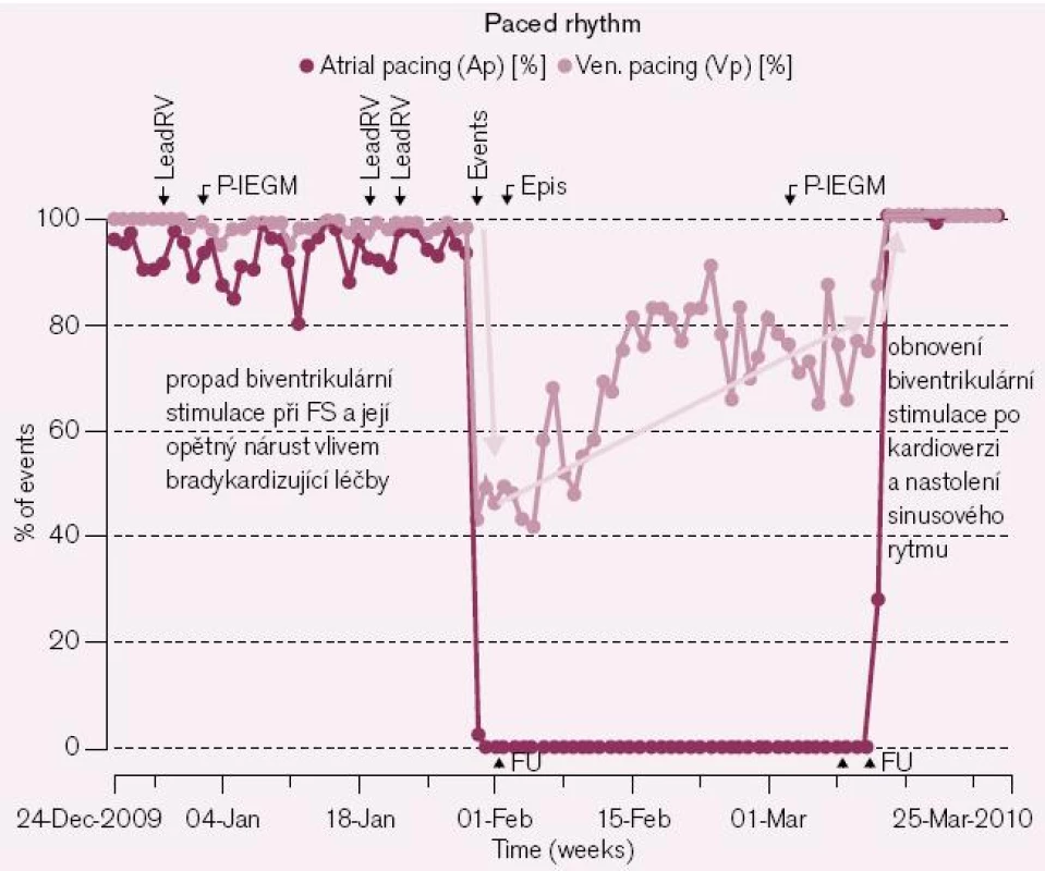 Ztráta synchronní stimulace biventrikulárního systému při setrvalém paroxyzmu FS (pokles síňové stimulace při FS na nulu při spontánní rychlé síňové aktivitě – 1 černý bod v grafu = záznam jednoho dne, zobrazen 0% podíl stimulace po dobu trvání arytmie) a její postupný nárůst bradykardizujícím efektem podávané medikace při saturaci amiodaronem (1 modrý bod v grafu = záznam jednoho dne, zobrazen narůstající podíl žádoucí komorové stimulace). K úplnému obnovení biventrikulární stimulace ovšem dochází až po provedení elektrické kardioverze s nastolením sinusového rytmu po 4týdenní účinné antikoagulaci.