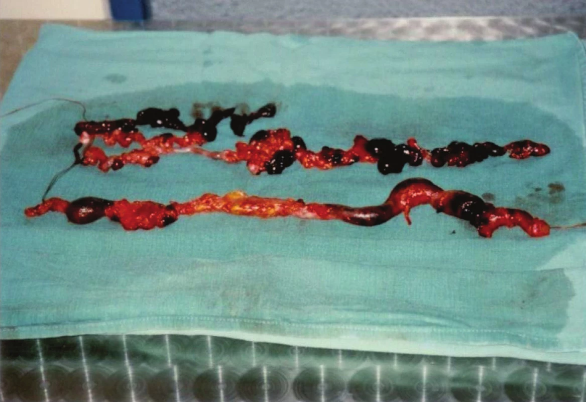 Preparát flebektomovaného kmene VSM stehna a bérce
Fig. 4: Specimen of GSV trunk with thrombophlebitis on thigh and shank