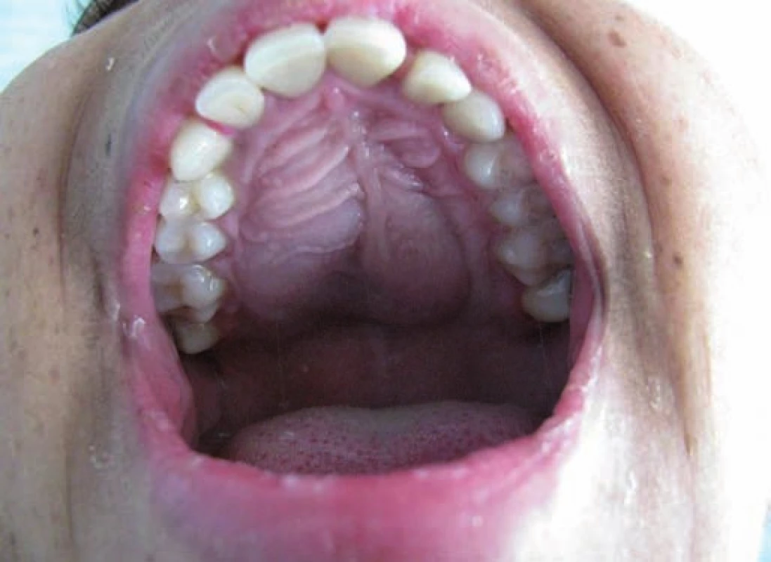 Vyklenutie a deformácia tvrdého podnebia.
Fig. 3. Buckling and deformation of the palate.