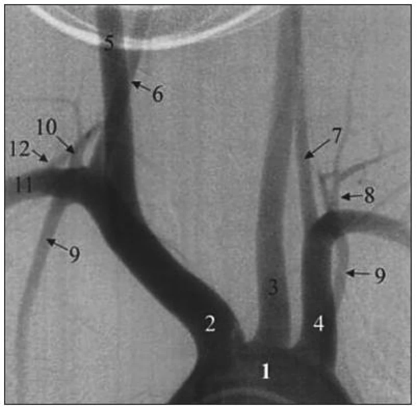 Normálne pomery v oblasti aortálneho oblúka a jeho vetiev.
Vysvetlivky: 1) aortálny oblúk; 2) truncus brachiocephalicus; 3) arteria carotis communis sin.; 4) arteria subclavia sin.; 5) arteria carotis communis dx.; 6) arteria vertebralis dx.; 7) arteria vertebralis sin.; 8) truncus thyreocervicalis sin.; 9) Arteria mammaria bilat; 10) Truncus thyreocervicalis dx.; 11) Arteria subclavia dx.; 12) Arteria cervicalis ascendens dx.
Fig. 1. Normal situation within the aortic arch and its branches region.
Explanatory notes: 1) aortic arch; 2) truncus brachiocephalicus; 3) arteria carotis communis sin.; 4) arteria subclavia sin.; 5) arteria carotis communis dx.; 6) arteria vertebralis dx.; 7) arteria vertebralis sin.; 8) truncus thyreocervicalis sin.; 9) Arteria mammaria bilat; 10) Truncus thyreocervicalis dx.; 11) Arteria subclavia dx.; 12) Arteria cervicalis ascendens dx.