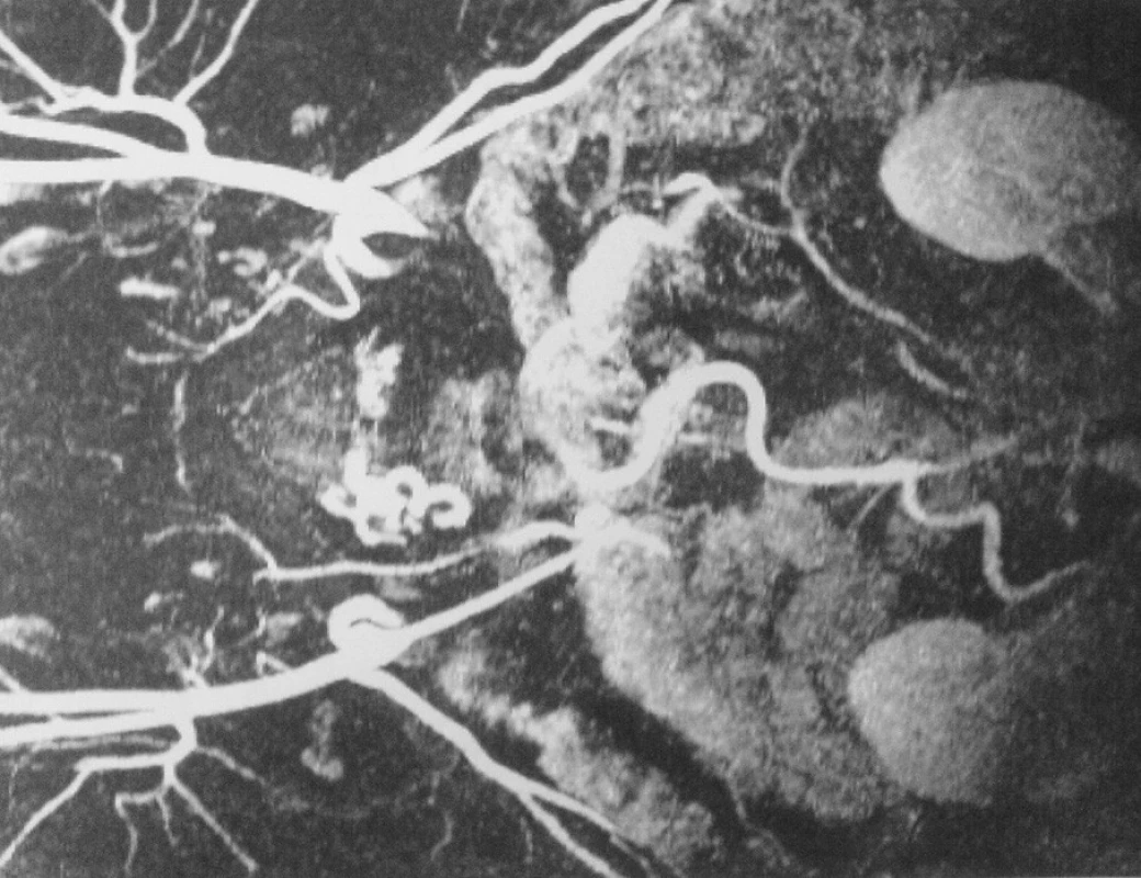 Uzávěr subrenální aorty
Fig. 1. Occlusion of the subrenal aorta