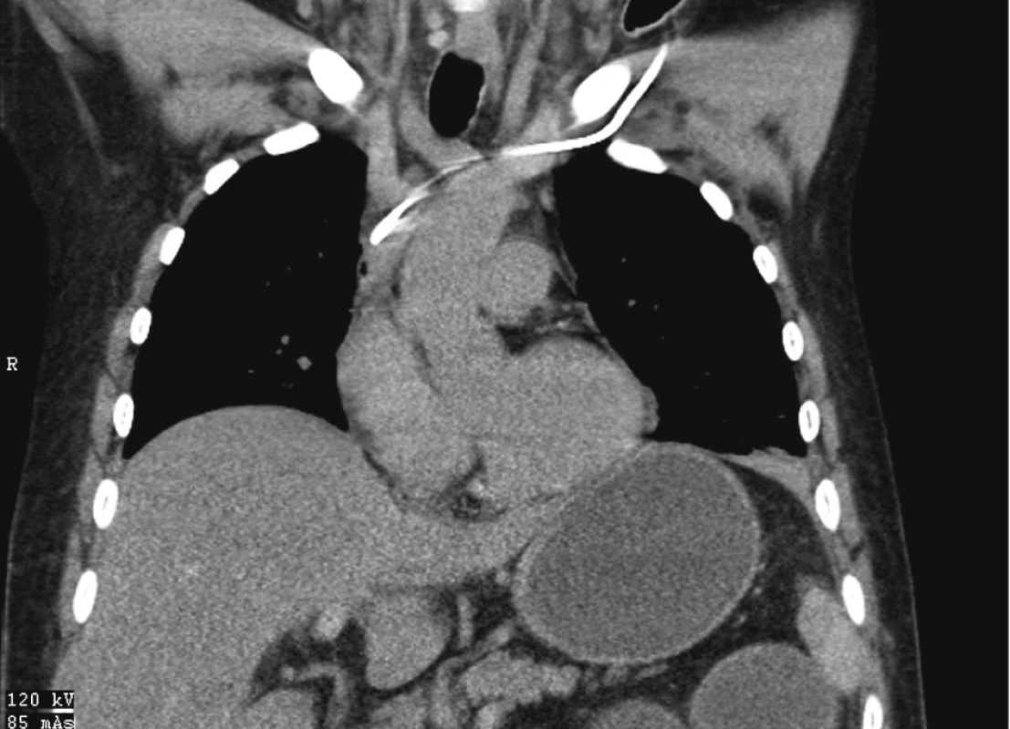 5 CT – nástřik CŽK bez úniku k.l.
Fig. 5. 5 CT scan – a contrast view of the central venous line – no leakage of the contrast matter is detectable