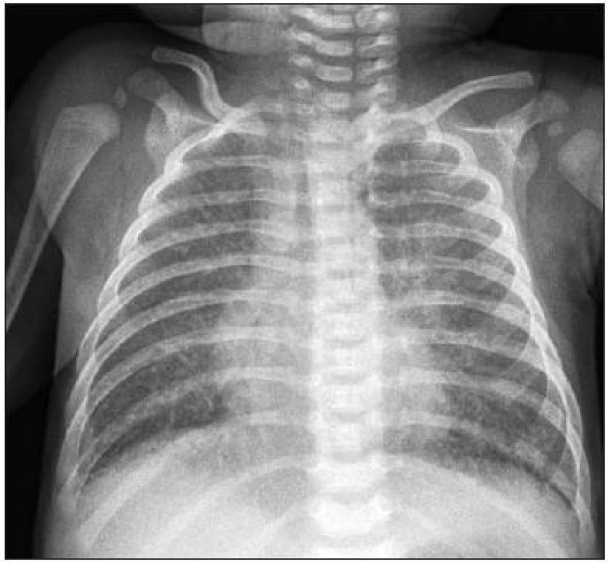 Zadopřední rtg srdce a plic, vstupní vyšetfiení: zmnožená bronchovaskulární kresba, kardiothorakální index 0,45.
Fig. 2. Anterior-posterior X-ray of the heart and lungs, entry examination: multiplied bronchovascular picture, cardiothoracic index 0.45