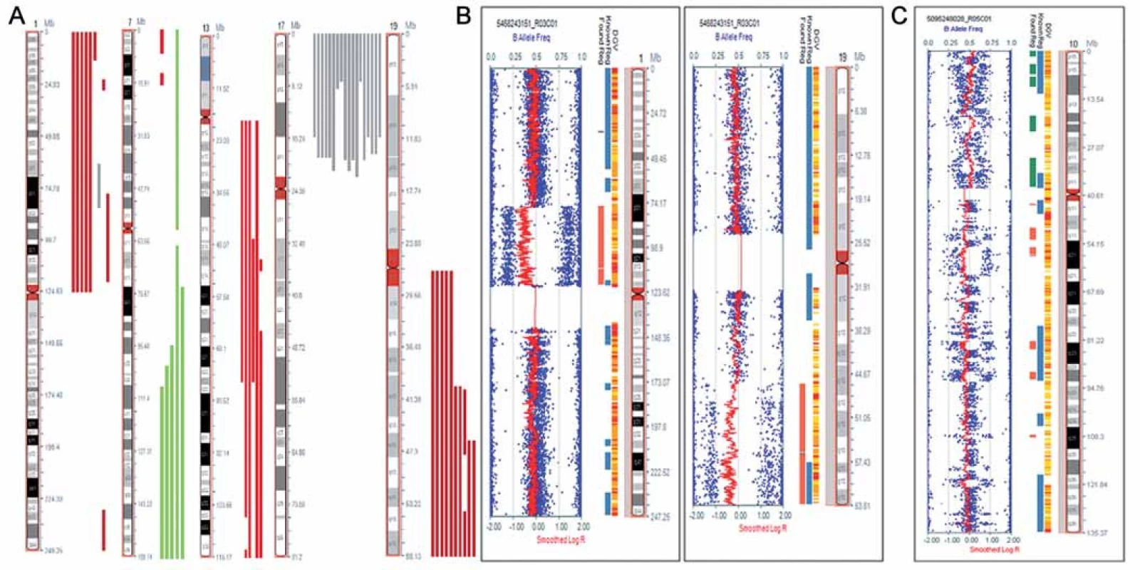 Chromozomové aberace detekované metodou SNP array. 
A. Rekurentní aberace na chromozomech 1, 7, 13, 17 a 19 nalezené u pacientů s astrocytomy. Červeně je znázorněn rozsah delecí, zeleně amplifi kací a šedě UPD. B. Kombinovaná delece1p/19q s atypickými zlomovými místy detekovaná u nemocného s astrocytomem. Rozsah delece je vyznačen červeně. Obrázek byl exportovaný z programu KaryoStudia (Illumina). C. Fragmentovaný chromozom 10 s četnými zisky a ztrátami genetického materiálu, pravděpodobně výsledek chromothripsis, detekovaný u nemocného s difuzním astrocytomem.
Obrázek byl exportovaný z programu KaryoStudia (Illumina).
