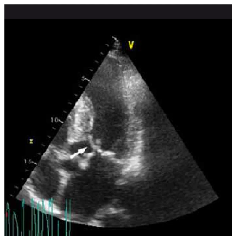 „Systolic anterior motion“ předního cípu mitrální chlopně (šipka) s dotykem mezikomorového septa.