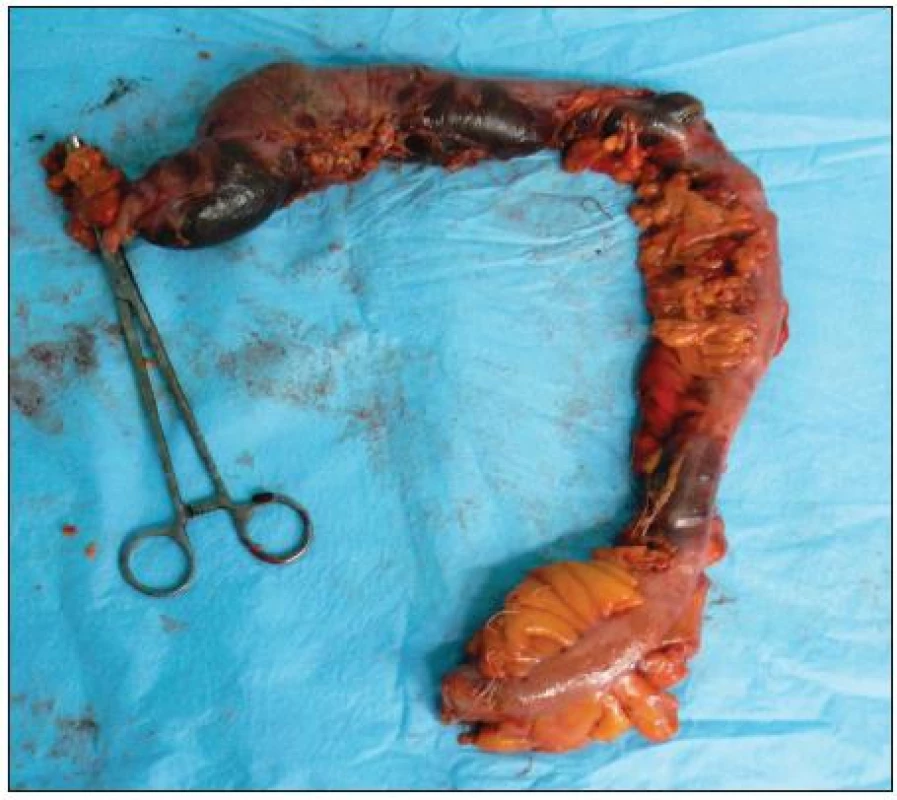 Resekát čreva s ložiskami nekróz
Fig. 2. Resected part of large bowel with visible transmural necrosis