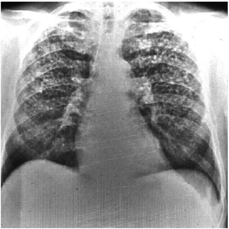 Prostá silikóza plic
S výjimkou plicních bazí jsou v celých plicích patrné početné malé opacity o velikosti do 10 mm.