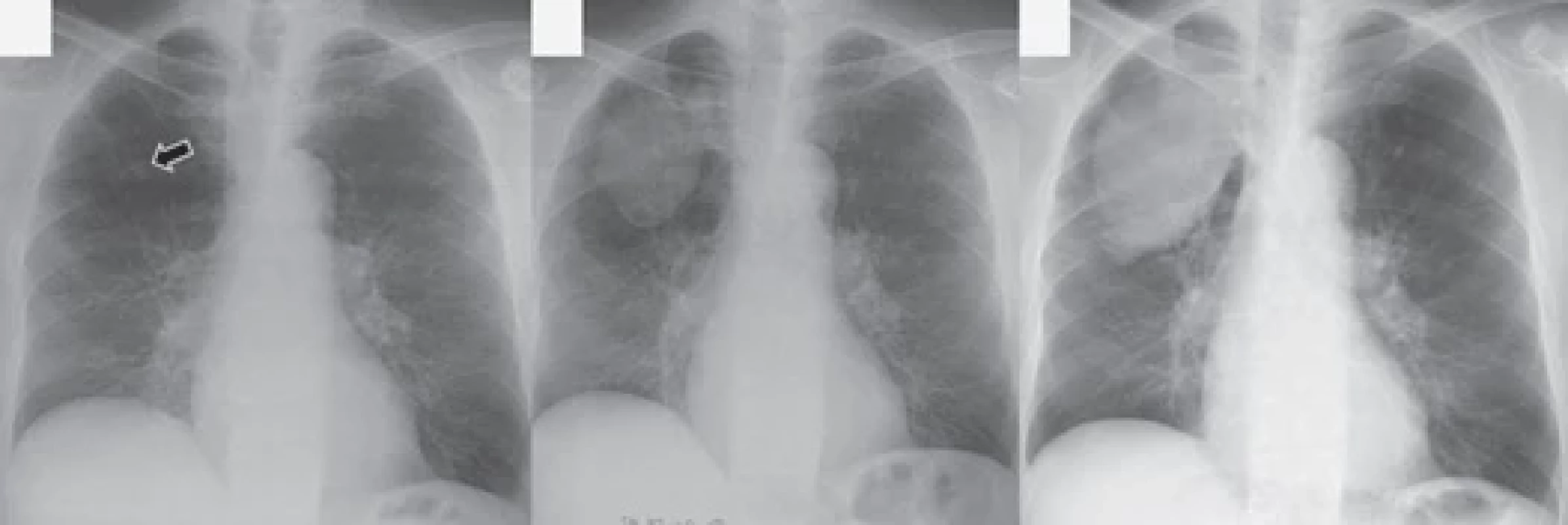 A chest radiograph taken when shortness of breath increased and bloody sputum appeared showed an 11 × 9 mm nodule in
the right upper lung fi eld (A). The nodule grew to 89 × 60 mm 9 weeks after the nodule was discovered (B), and the size of the nodule
taken 11 weeks after the nodule increased to 102 × 68 mm (C). Fluorodeoxyglucose-positron emission tomography / computed
tomography (FDG-PET/CT) performed before the start of treatment showed signifi cant uptake of FDG in most part of the mass (D).