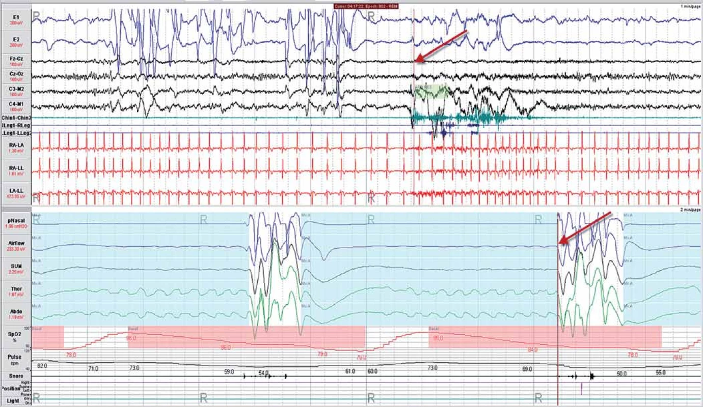 Příklad smíšené spánkové apnoe, jedná se o kombinaci centrální a obstrukční spánkové apnoe. Šipky ukazují na místo se stejným časem v polysomnografickém záznamu, kdy respirační událost je doprovázena probouzecí reakcí (arousal). Popisy jednotlivých snímaných signálů jsou vysvětleny v části: Hodnocení polysomnografického záznamu. Za pozornost stojí závažnost desaturace, generovaná jednotlivými epizodami SDB.