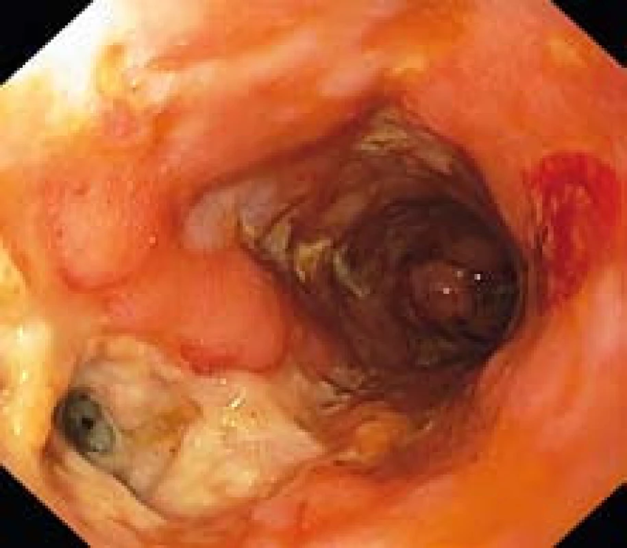 Endoskopický pohled do anorektálního přechodu s hlubokým vředem a ústím píštěle.
Fig. 1. Endoscopic view to the anorectal junction with deep ulcer and fistula orifice.