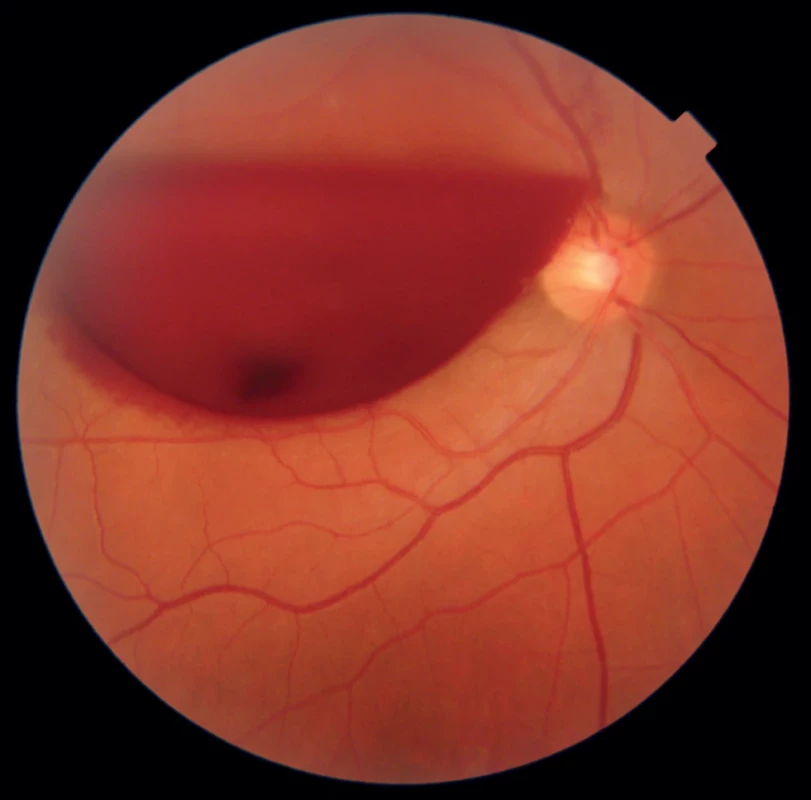 Photo of macular area before Nd-YAG hyaloidotomy